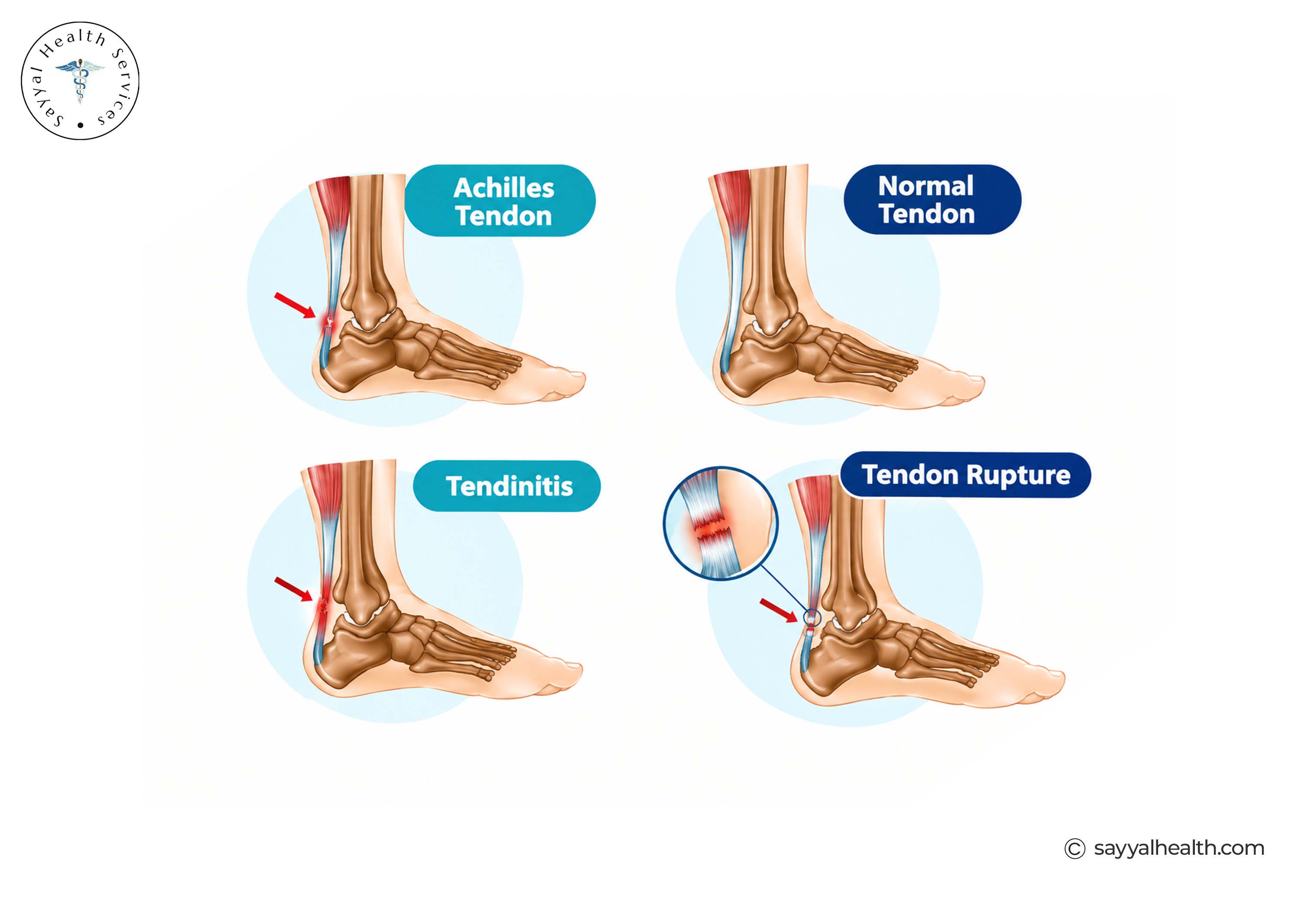 Types of Tendon Injuries